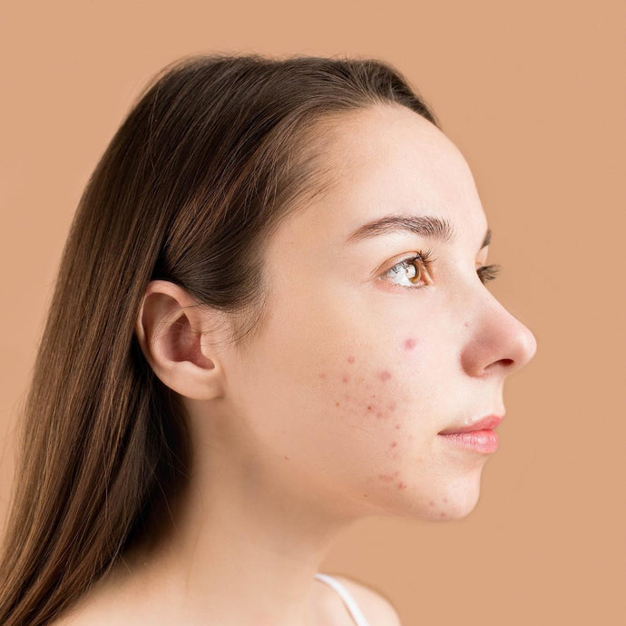 What is the difference between acne and pimples?